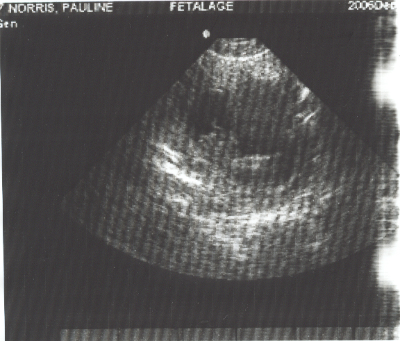 Ultrasound of our new baby